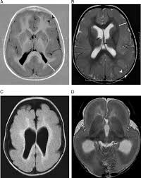 Lissencephaly is a rare disorder in which a baby's brain doesn't develop folds or grooves. Agyria Pachygyria Band Spectrum Chapter 46 The Causes Of Epilepsy