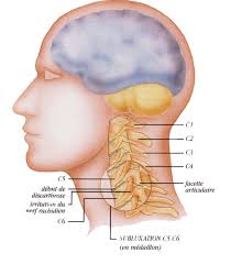 Sustantivo de género exclusivamente femenino, que lleva los artículos la o una en singular, y las o unas en plural. Torticolis Traitement Produits Chiropratiques Que Faire Chiro Comeau