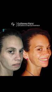 Nuevo caso clínico y otra cirugía transformadora 💫💫, ., Yamila es una  paciente que fue diagnosticada con asimetría facial debido a una  maloclusión severa, un canteo del plano oclusal y clase 2 ...