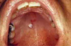 Image result for papillomavirus tongue)
