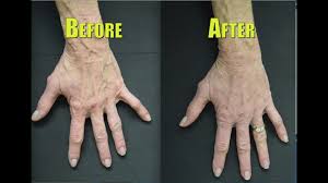Maybe you would like to learn more about one of these? Rejuvenate Your Hands By Fixing Bulging Veins