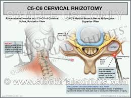 C5 C6 Cervical Rhizotomy Stock Medical Illustration Female Cervical Radiofrequency Ablation Medical Malpractice Cases