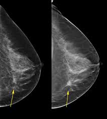 Pin On Breast Cancer Research News