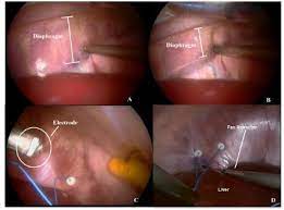 Scielo Brasil Technique For Implanting Intramuscular Electrodes In The Diaphragm By Videolaparoscopy In Pigs Technique For Implanting Intramuscular Electrodes In The Diaphragm By Videolaparoscopy In Pigs