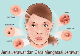 Tak hanya dengan bahan alami, cara menghilangkan jerawat secara alami juga bisa dilakukan dengan tea tree oil berguna untuk mengurangi peradangan pada jerawat. Cara Menghilangkan Jerawat Komedo Flek Hitam Dan Bekasnya Home Facebook