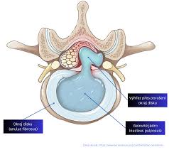 Image result for vyhřezlá ploténka