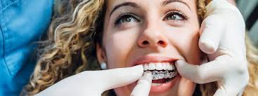 Clear Aligners and Braces Del Mar CA