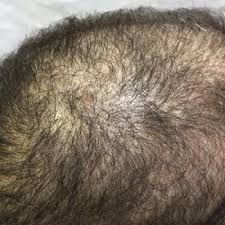 Click on the article to find out. Nonscarring Alopecia Associated With Vitamin D Deficiency Mdedge Dermatology