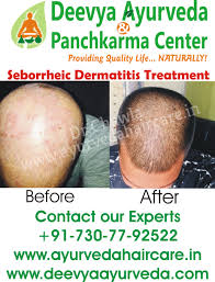 Seborrheic dermatitis can also appear on other parts of the body including the groin, legs, creases of the arms and the chest. Articles Seborrheic Dermatitis Causes And Symptoms For Deevya Ayurveda Panchkarma Center