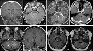 Clippers sendromu merkezi sinir sisteminin inflamatuvar bir hastalığıdır. Is Chronic Lymphocytic Inflammation With Pontine Perivascular Enhancement Responsive To Steroids Clippers In Children The Same Condition As In Adults Sa 2019 Developmental Medicine Amp Child Neurology Wiley Online Library