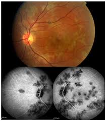 Have you experienced a rapid loss of vision that eventually has. Diagnostics Free Full Text Classification Of Non Infectious And Or Immune Mediated Choroiditis A Brief Overview Of The Essentials