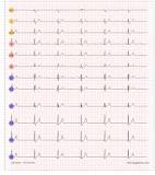 Image result for icd 10 code for mobitz type 1