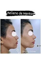 Con los rellenos de Ácido Hialuronico podemos corregir/rellenar cualquier  simetría anatomica 💉👳, En este caso que necesitamos proyectar la zona,  usamos un producto de características densas., ...