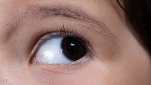 Selain mitos, sebenarnya kedutan pada mata juga bisa menandakan kondisi tubuh. Nistagmus Pada Mata Ini Gejala Dan Penyebabnya