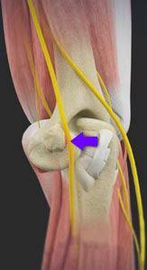 Cubital Tunnel Release Carmel In Ulnar Nerve Entrapment Fishers Avon South Bend Franklin In