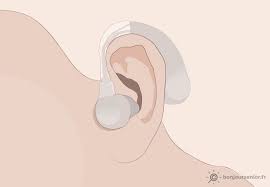 Appareil Auditif Contour D Oreille En 2020 Appareil Auditif Appareil Composant Electronique