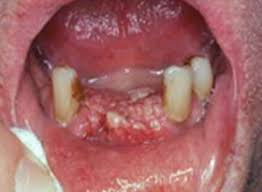 Learn the signs of jaw cancer here. Oral Cancer Images The Oral Cancer Foundation