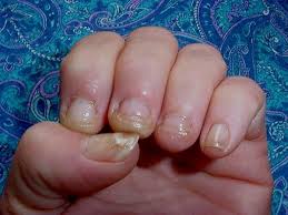 Nail fungus can cause the nail to become thick or ragged and appear yellow, green, brown or black. Nail Fungus From Acrylic Nails New Expression Nails