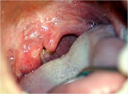 Image result for Hand foot and mouth disease HFMD roof of mouth