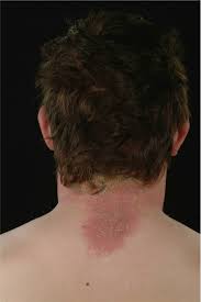 Allergic reactions to hair dye rarely appear the first time you color your hair. Para Phenylenediamine Allergy Current Perspectives On Diagnosis And M Jaa