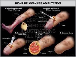 Bka Amputation How Its Done Cool To See Since I Wasn T Awake At The Time Prosthetic Leg Below The Knee Amputation Nursing School Tips