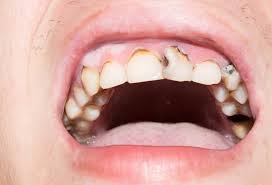 Eifrig wurden die verschiedenen lebensmittel in „gut oder „schlecht eingeteilt. 13 Ursachen Fur Zahnschmerzen Was Sie Dagegen Tun Konnen Dentalplanet