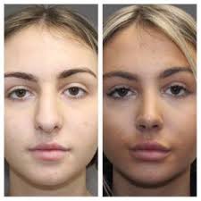 The length of the procedure and the technique used will depend on how much your nose needs to be altered. Rhinoplasty London Nose Job London Rhinoplasty Cost London