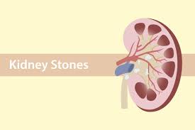 Kidney Stones What S Your Risk