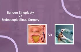 Image result for Sinus Surgery