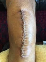 Give it time, 8 weeks is rather early, it will come when you can walk naturally again. 2 Months After Tkr Surgery Scars Pain And Progress