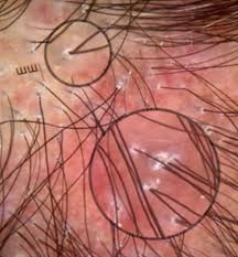 It can also cause hair loss. Lichen Planopilaris And The Eye Donovan Hair Clinic