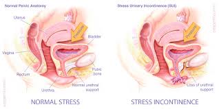 Image result for Stress Incontinence