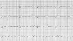El poate apare normal la tineri atleti. Av Block 2nd Degree High Grade Av Block Litfl Ecg Library
