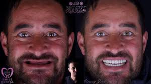 💜💜 . . . . . . . . . . . . . . . . #dentistry #dent #dentista  #dentalcrown #dr #dentist #doctor #dentaire #dentaloffice #dental #dz  #dentiste #dentiste #dentistryworld #dentalveneers #