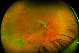 An optomap® retinal exam provides: Retinal Holes And Tears Recognizing Pathology Optos