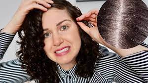 If your primary problem is itch, that is most often caused by dryness, and just getting water to the itchy areas can help. Dry Scalp Product Buildup Dandruff Simple Treatment Prevention Youtube