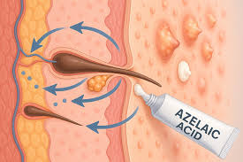 Image result for Comedolytic