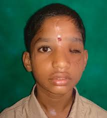 Complete Globe Avulsion in a 13-Year-Old Young Boy with Maxillofacial  Injury: A Case Report and Review of Literature