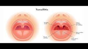 While hydrogen peroxide is very nasty in its undiluted form, in solution form it can be very helpful in breaking down food stuck in the throat. Why Does It Feel Like Something Is Stuck In My Throat And What Disease Symptoms Is This Tamil Youtube
