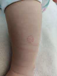 Image result for vyrážka u dětí