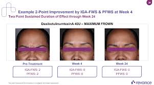 revance therapeutics a new contender in the botox arena