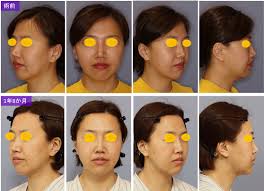 顔面と首を糸リフトで引き上げる ～１年８か月の長期経過もお見せします～|宮益坂クリニック