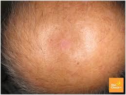 Symptoms more specific to invasive breast cancer are: Skin Cancer On Scalp Skin Check Waskin Check Wa
