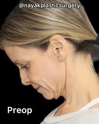 Abbe, 52, was my live surgical model for the TeoNayak Masterclass in  Istanbul 3 months ago. Her surgery consisted of upper blepharoplasty,  browlift, preservation deep plane extended facelift, deep necklift, a touch