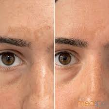 Image result for Melasma