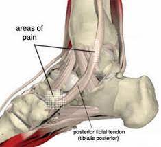 Posterior Tibial Tendon Dysfunction