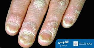 الصدفية.. ماذا أفعل لتحسين مظهر أظافري؟