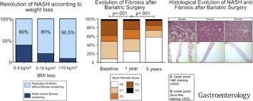 Bariatric Surgery Provides Long Term Resolution Of Nonalcoholic Steatohepatitis And Regression Of Fibrosis Sciencedirect