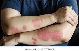 Image result for Eczema nummulare