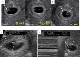 6 weeks pregnant and the changes in your growing baby (and your body) continue big time. Early Pregnancy Ultrasound Measurements And Prediction Of First Trimester Pregnancy Loss A Logistic Model Scientific Reports